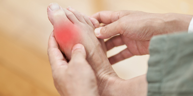 Prévenir les crises de goutte naturellement