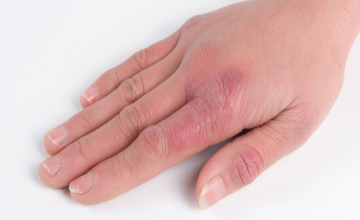 Prévention Hivernale : Protéger ses mains contre les engelures,