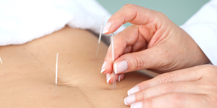 acupuncture-minceur