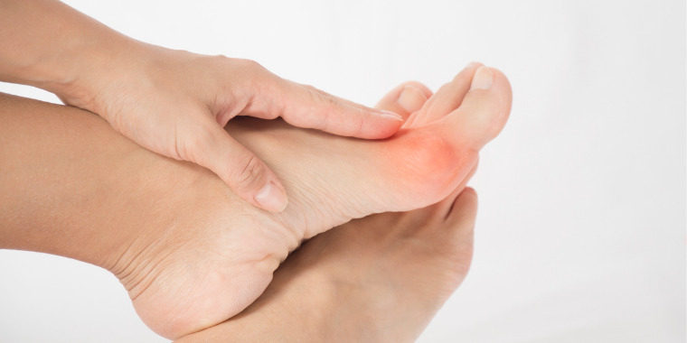 Des exercices pour traiter l'Hallux Valgus